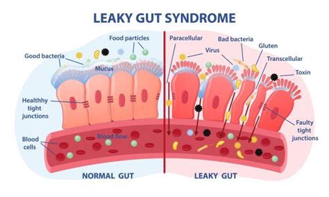 tests for intestinal permeability|does leaky gut cause diarrhea.